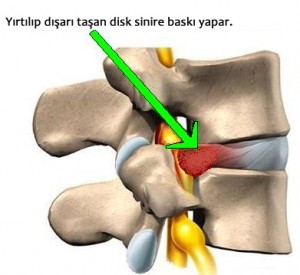 bel fıtığı 1