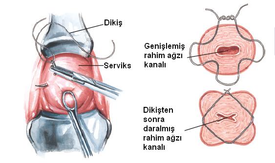 servikal yetmezlik