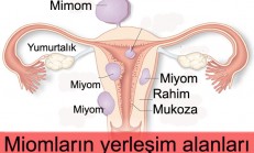 Miyom Hamilelikte Sorun Yaratır mı?