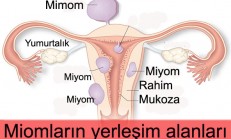 Miyom Hamilelikte Sorun Yaratır mı?