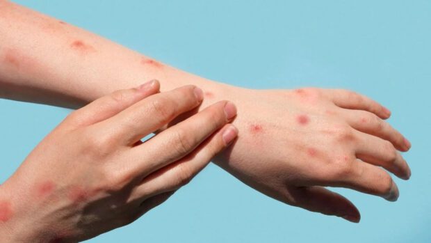 16 Yaşında Çiçek Hastalığına Yakalandı Ayakları Şişti Eklemlere ve Ciğerlere İndi